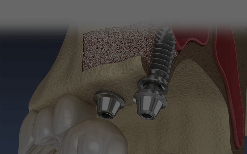 大津市 インプラント